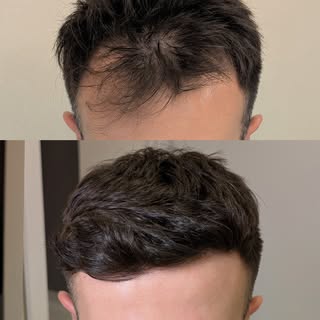 2400 grafts – FUE / DHI – Hairline & temple restoration. Photos taken 10 months after the procedure.