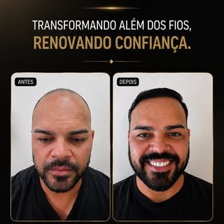 Cada resultado conta uma história.

O transplante capilar vai além de recuperar fios: ele devolve co