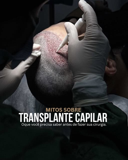 O transplante capilar ainda é cercado por dúvidas e informações que nem sempre são verdadeiras. A té
