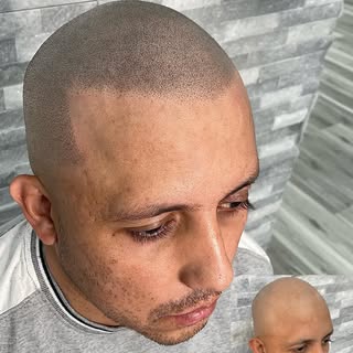 ✨Hairline transformed✨

REALISM TREATMENTS

Realism technique places the impressions really close to
