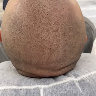 1st session! 🪄

Creating a nice natural hairline! 👌

World Class SMP💥

DM for details

#hairloss 