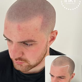 REALISM SMP

Undetectable results! @laserandco_carlisle 

BOOK A FREE CONSULTATION 

www.inkt-scalp.