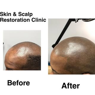 **💈 Tired of shaving, hats, or hair loss struggles?** 
Scalp Micro Pigmentation gives you a **natur