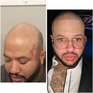 **🔥 Restore Your Confidence with a Flawless Hairline! 🔥** 
Say goodbye to thinning hair & hello to