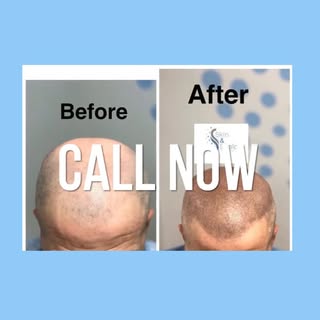 **💈 Tired of shaving, hats, or hair loss struggles?** 
Scalp Micro Pigmentation gives you a **natur