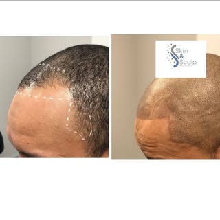 Hairline reconstruction! Schedule your free consultation now 💥💥💥💥💥💥💥💥💥💥💥💥💥💥💥💥💥💥💥

