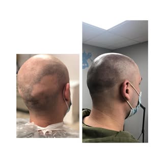 **💈 Tired of shaving, hats, or hair loss struggles?** 
Scalp Micro Pigmentation gives you a **natur