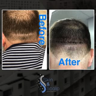 **💈 Tired of shaving, hats, or hair loss struggles?** 
Scalp Micro Pigmentation gives you a **natur