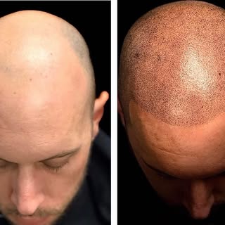 SMP: your secret weapon against hair loss 🕵️‍♂️ 937-723-7759 ☎️ 📧 ssrc@skinandscalprestoration.com