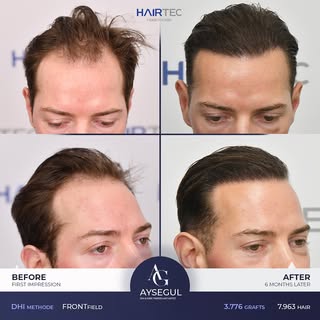 Natural Hairline – 6 Months Result 💎
A perfectly designed DHI Hairline that combines naturalness an