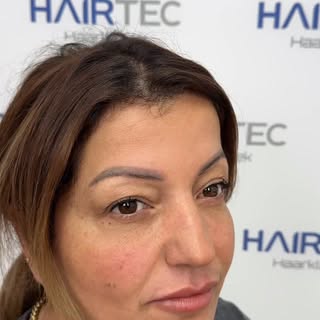The New Generation Eyebrow Transplant Technique is Here at Hairtec!
After years of refinement, I’m p