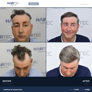 3,020 Grafts Micro DHI Hair Transplant
Area: Hairline & Temples
Technique: Micro DHI
Result: 12 mont