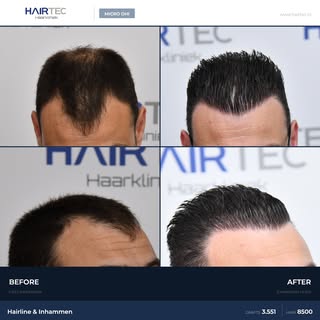 3,551 Grafts Micro DHI Hair Transplant

Area: Hairline & Temples
Technique: Micro DHI
Result: 12 mon