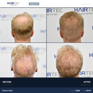 3,560 Grafts Micro DHI Hair Transplant
Area: Crown
Technique: Micro DHI
Result: 12 months post-op
Pr