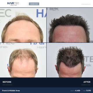 4,430 Grafts Micro DHI Hair Transplant
Area: Front & Middle Area
Technique: Micro DHI
Result: 6 mont