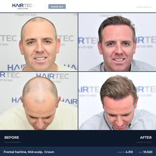 4,310 Grafts Micro DHI Hair Transplant

Area: Front, Middle & Crown (Full Coverage)
Technique: Micro