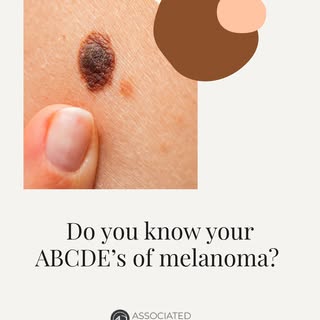 When it comes to melanoma, early detection is key. The ABCDE guide can help you recognize changes in