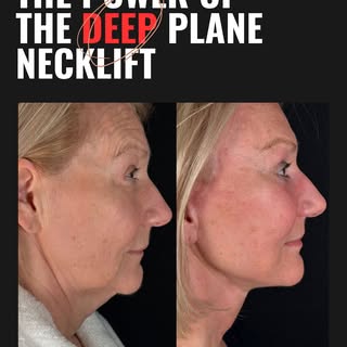 The Power Of The Deep Plane Necklift 🥊