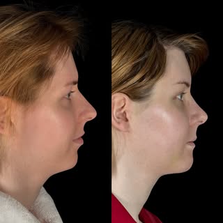 Subtle changes - 3.5 weeks post-op 

This lovely patient underwent hairline lowering, forehead recon