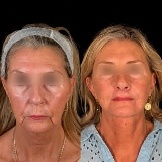 One of the most common misconceptions in facial rejuvenation is that aging occurs only at the level 