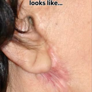 What people think a deep plane facelift scar looks like…

The first image? That’s what happens when 