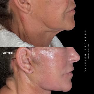 Two weeks after a deep plane face & neck lift with deep neck reduction.

At just two weeks, healing 