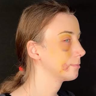 2 weeks post-op. The journey has only just begun. ❤️

#facialfeminizationsurgery #face2faceclinic
