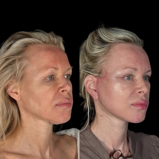 Six and a half weeks post-op — and this is still only the beginning. 😎

This patient underwent:

• 
