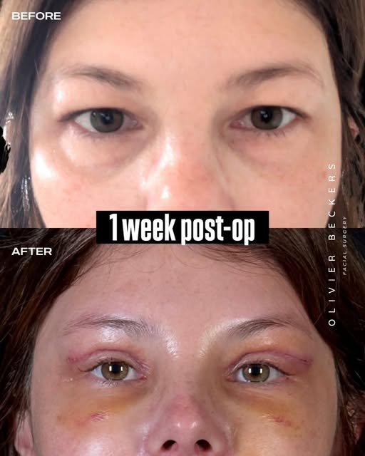 One week post-op after upper blepharoplasty combined with a brow reset 👀

The goal was not to chang
