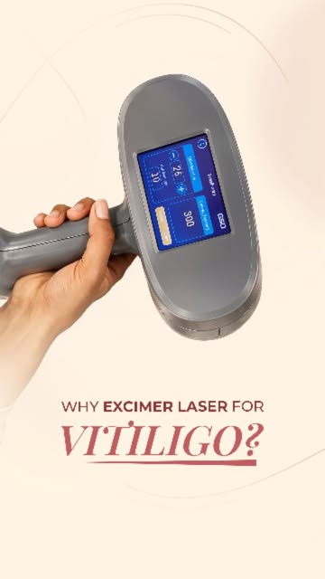 Excimer Laser offers a more targeted approach for conditions such as vitiligo, psoriasis, and alopec