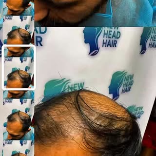 3,500 Grafts. Less Than 7 Hours. One Life-Changing Transformation.

This gentleman came to us with a
