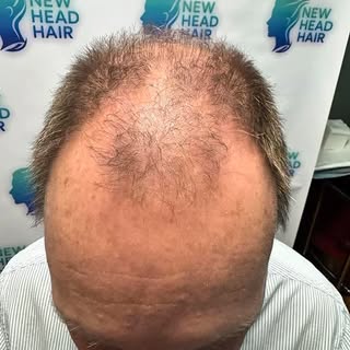 3,000 grafts. One life-changing transformation in the making.

This patient came to us with advanced