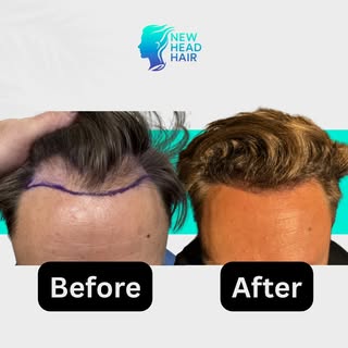 2,000 Grafts. 6 Months. Life-Changing Progress.

At just 6 months post-op, this patient is already s
