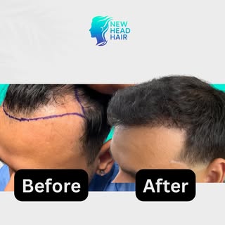 This is why I love what I do.

We’re not just restoring hair—we’re restoring confidence, self-esteem