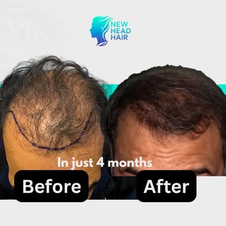 🚨 Just 4 months post-op. 🚨

Look at the difference.

✅ Natural hairline
✅ Noticeable density
✅ Hai