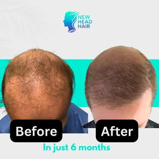 This isn’t just a hair transplant result. This is a second chance.

This patient came to us after a 