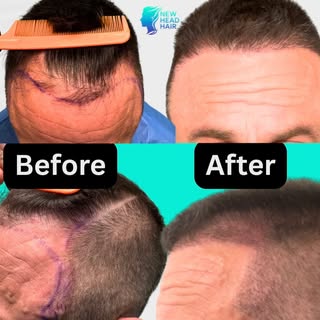 🔥 2,500 GRAFTS. JUST 6 MONTHS. 🔥

What a transformation — and we’re only at the halfway point.

Ju