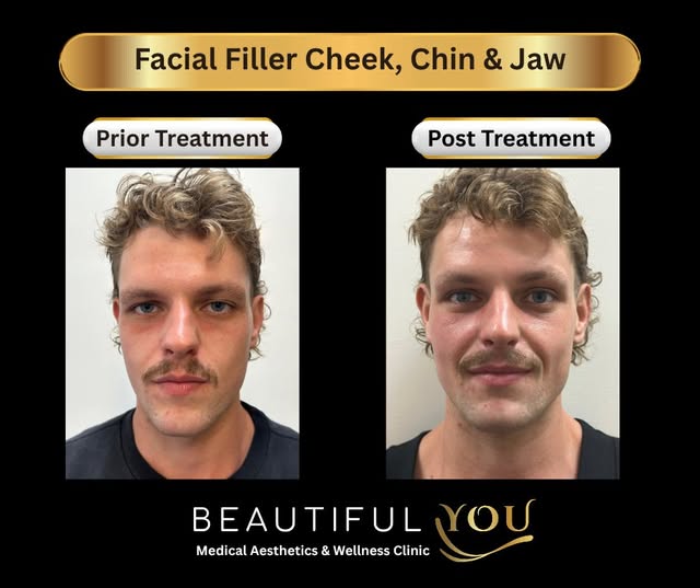 Male facial balancing isn’t about changing the way you look—it’s about creating better proportion wh