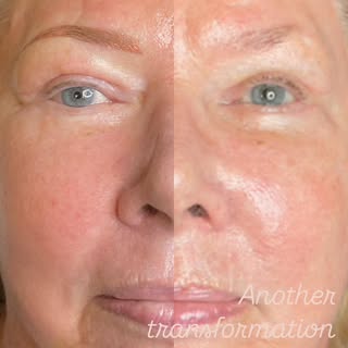 🤩 From barely there to sculpted…. the results are amazing! Want to upgrade your brow game?

Treatme