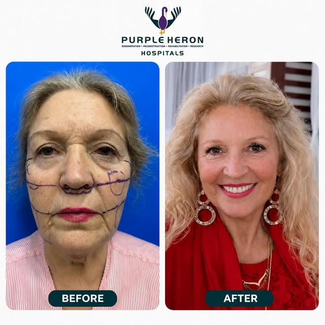 FROM GERMANY TO INDIA A BEAUTIFUL FACIAL TRANSFORMATION! 
A journey across borders for a refreshed, 