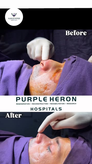 Non-Traumatic Piezotome-Assisted Rhinoplasty 
A precision-focused rhinoplasty performed by Dr. Nites