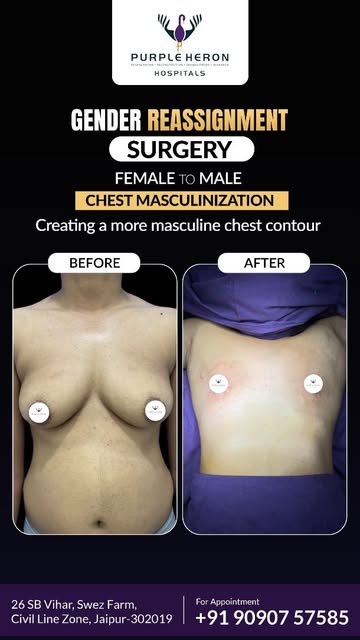 ✨ Gender-Affirming Top Surgery: A Chest That Aligns With Your Identity 🩺💙

For many individuals, g