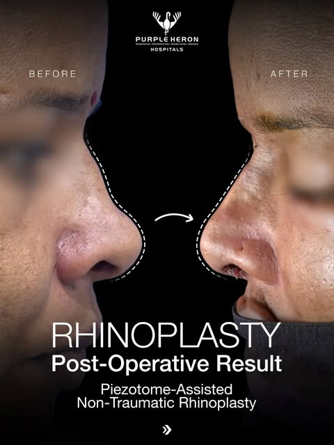 ✨ Precision That Shapes Natural Results. 👃💙

This Piezotome-Assisted Non-Traumatic Rhinoplasty res