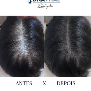 Queda capilar tem causa, e causa tem tratamento quando existe diagnóstico correto!

Essa paciente nã