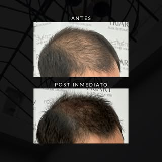 Resultados a corto y largo plazo. 
Con la técnica de Long Hair Fue empezás a disfrutar tu cambio de 