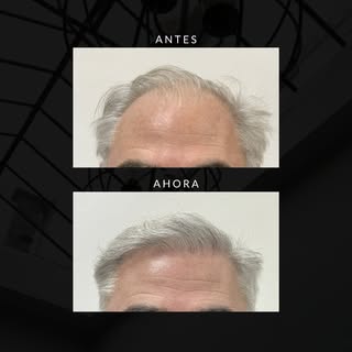 Cada paciente, una historia.
Nos enorgullece compartir y acompañar estos procesos.

💉 Yriart Hair R