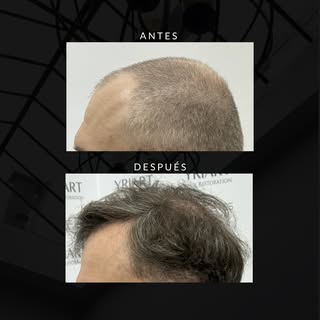 ✨Hay pacientes que nos confían un proceso✨ 
Compartimos estos resultados con orgullo.

💉 Yriart Hai