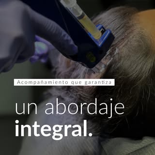 El trasplante no siempre es el primer paso.

No todos los casos requieren un implante capilar en una