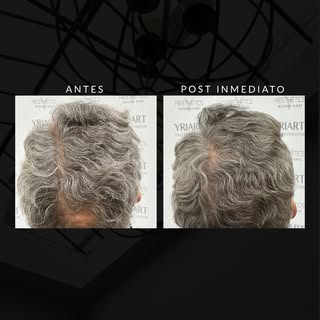 Ver hoy, los resultados del futuro.
Con la técnica de Long Hair FUE el paciente ve resultados inmedi