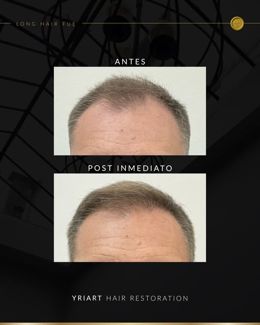 ✨Un trabajo milimétrico que marca la diferencia✨

El tratamiento a tu medida existe y puede empezar,